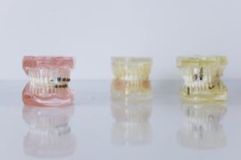 Quels sont les avantages de l'alignement dentaire ?